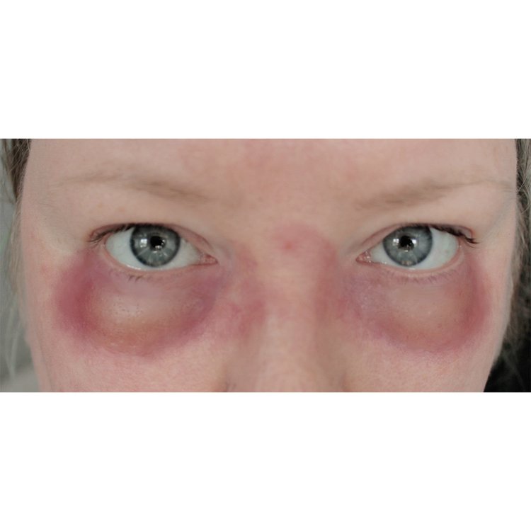 JessFX Moulds - Under Eyes Swelling